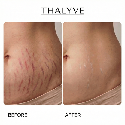 THALYVE™ Evolved Stretch Mark Stick